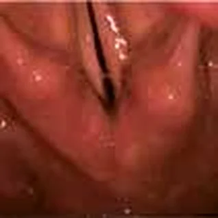 Bilateral paralysis of the vocal cords (after total thyroidectomy) — Bilateral paralysis of the vocal cords