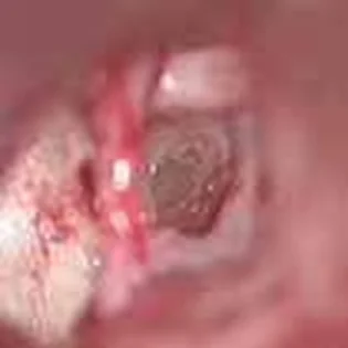 “ONE SHOT” stapedotomy — With CO₂ laser