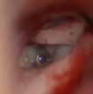 “ONE SHOT” stapedotomy — With diode laser