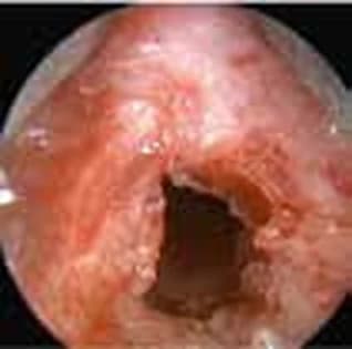 Recurrent respiratory papillomatosis — After removal of the papilloma (obvious glottic stenosis)