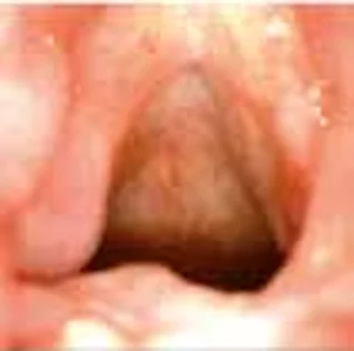 Recurrent respiratory papillomatosis — 11 months follow-up (after 4 procedures)