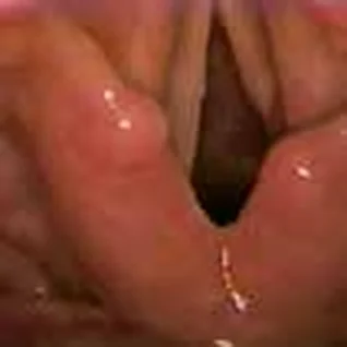 Bilateral paralysis of the vocal cords (after total thyroidectomy) — 6 months follow-up