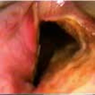 Bilateral paralysis of the vocal cords (after total thyroidectomy) — Posterior cordotomy