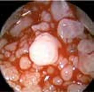 Recurrent respiratory papillomatosis — Recurrent respiratory papillomatosis