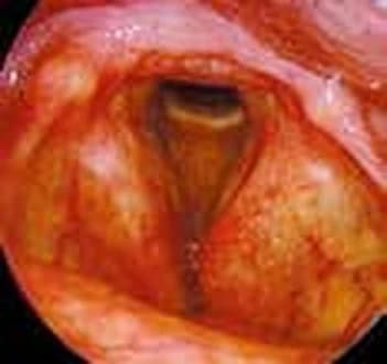 Squamous cell carcinoma (T1a) — 12 months follow-up