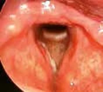 Squamous cell carcinoma (T1a) — Squamous cell carcinoma (T1a)