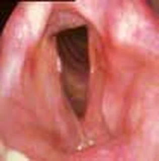 Squamous cell carcinoma (T3) — 6 months follow-up