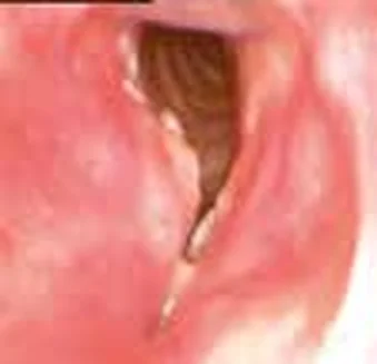 Squamous cell carcinoma (T3) — Squamous cell carcinoma (T3)