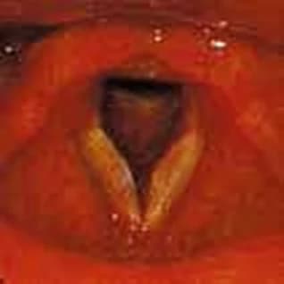Left vocal cord polyp — 3 months follow-up