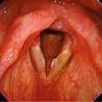 Left vocal cord polyp — Left vocal cord polyp